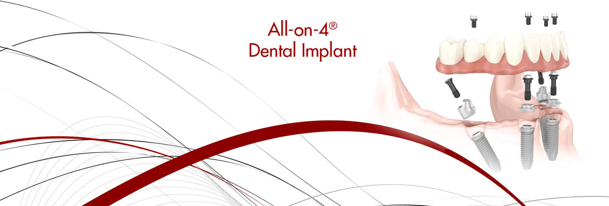 Peoria All-on-4 Dental Implants