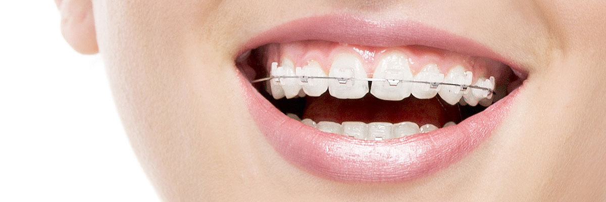Peoria Invisible Orthodontics