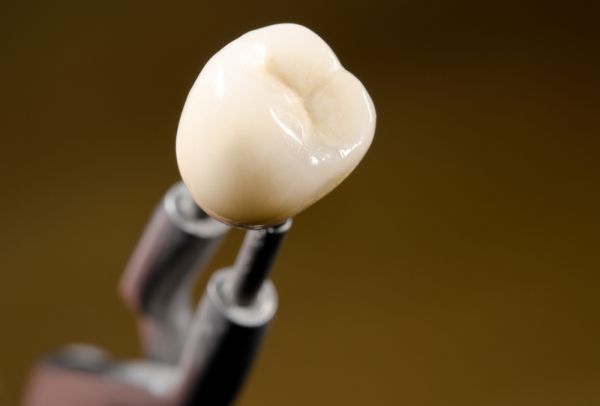 What To Know About The Dental Crown Process