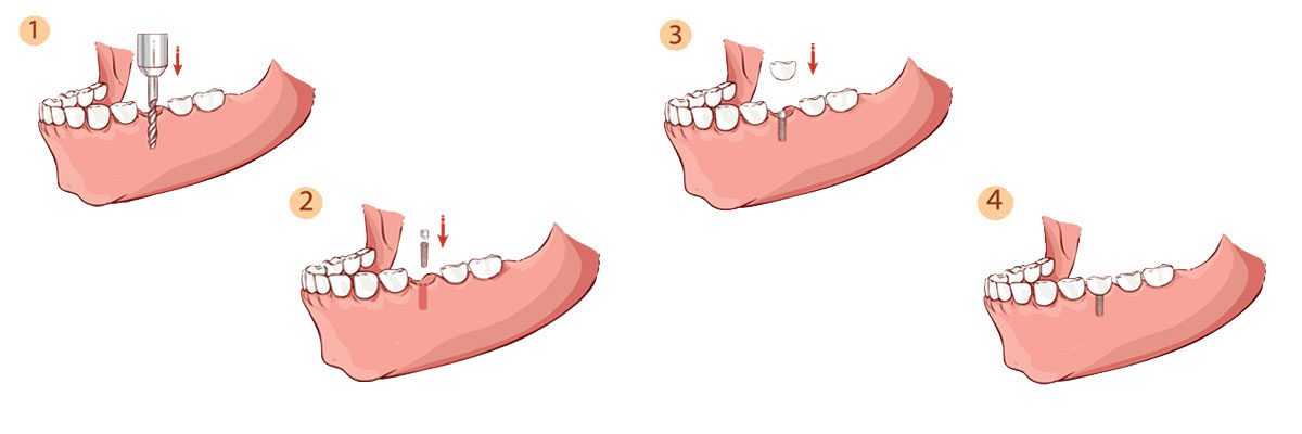 Peoria Dental Implant Restoration