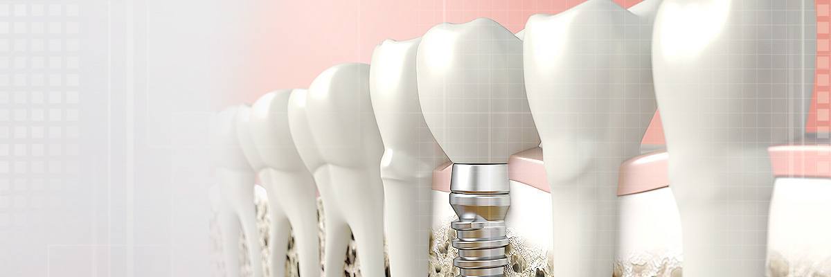 Peoria Dental Prosthetics
