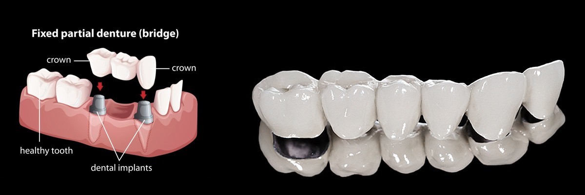 Peoria Dentures