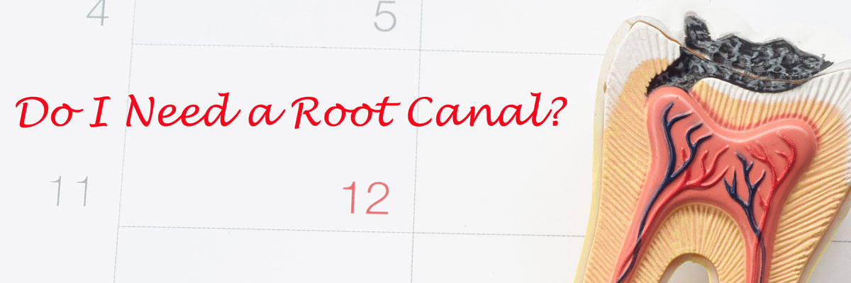 Peoria Do I Need a Root Canal