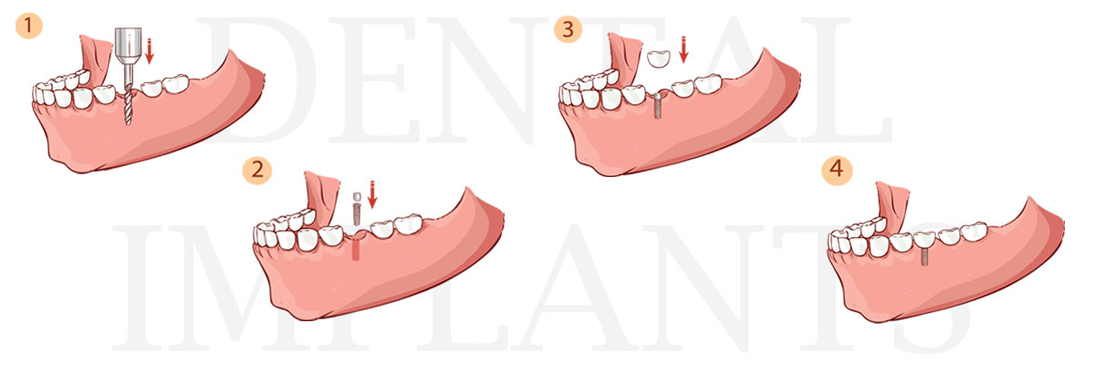 Peoria The Difference Between Dental Implants and Mini Dental Implants