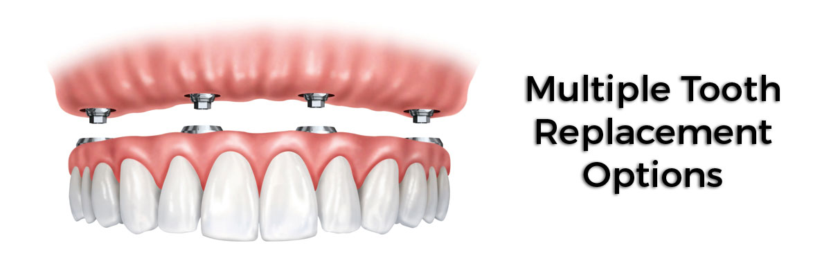 Peoria Multiple Teeth Replacement Options