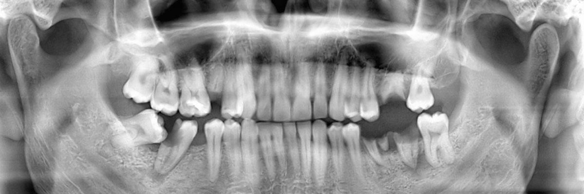 Peoria Options for Replacing Missing Teeth