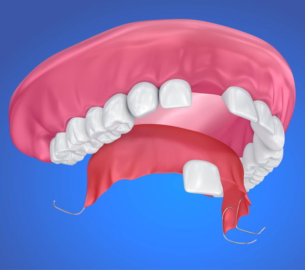 Peoria Partial Denture for One Missing Tooth