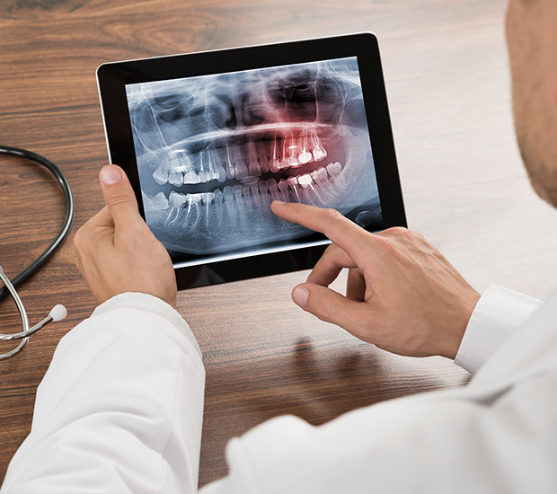 Peoria Types of Dental Root Fractures