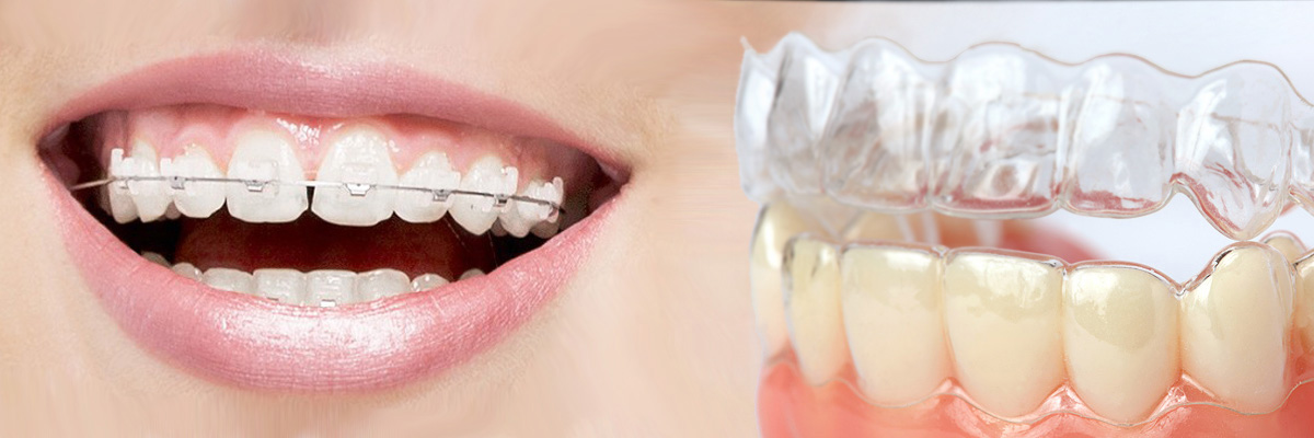 Peoria Which is Better Invisalign or Braces